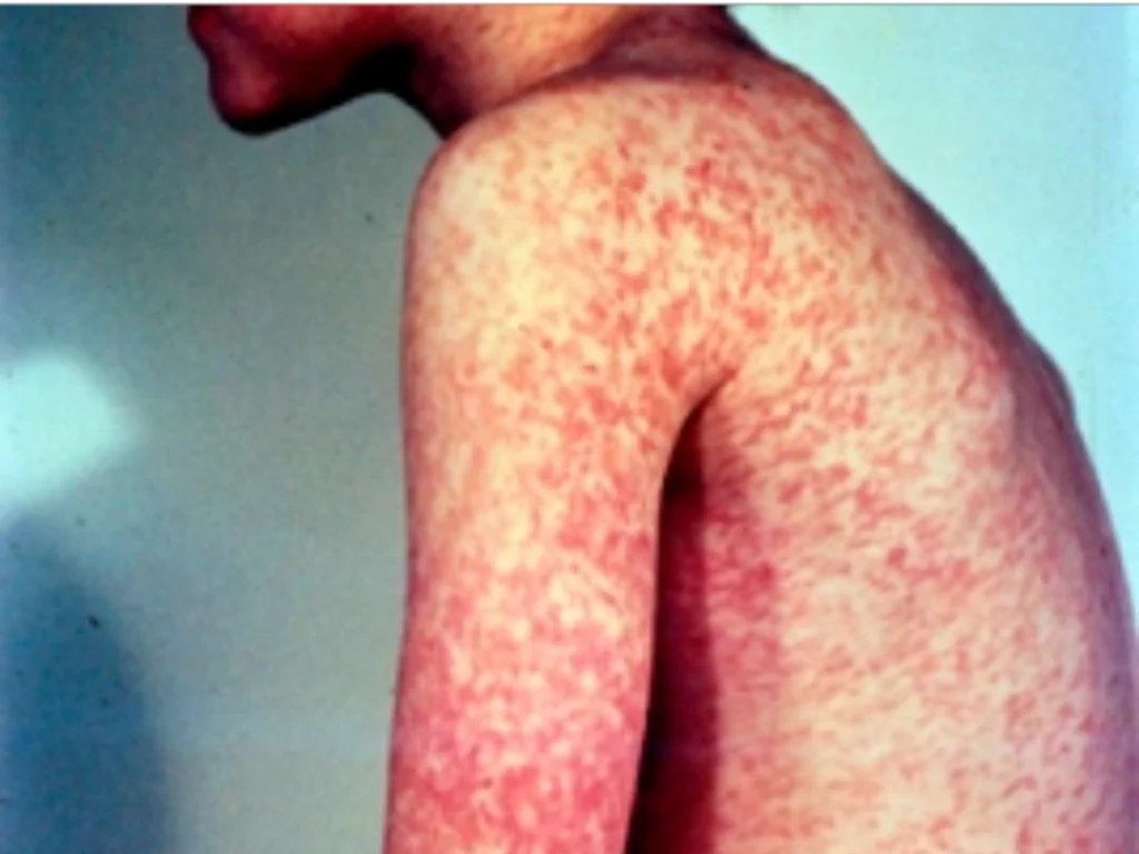 Pánico Sanitario: Canadá Perdona Estatuto Libre de Sarampión, Poniendo en Peligro la Salud de Márgenes Norteamericanos